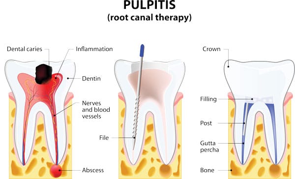 Root Canal Therapy Diagram