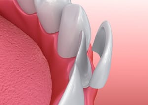 Diagram of Porcelain Veneers