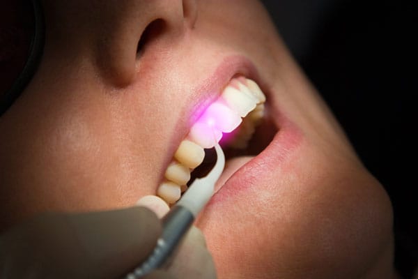 Laser Dental Treatments Calgary - Laser Therapy NE Calgary, AB