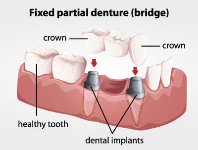 Fixed Partial Denture (Bridge) Diagram