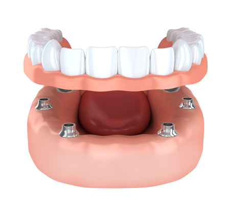 Implant Retained Dentures