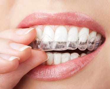 Healthy Smile Using Invisalign