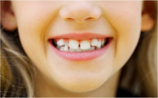 Child smiling who could benefit from orthodontic treatment.