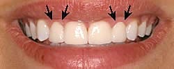 Smile After Gum Recontouring