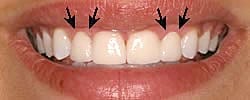 Diode Laser Gum Contouring After Braces