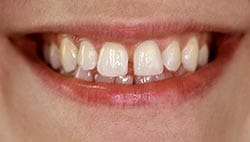 Photo of a smile with gaps between their teeth (diastema).