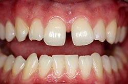 Photo of a smile with large gap between their teeth (diastema).